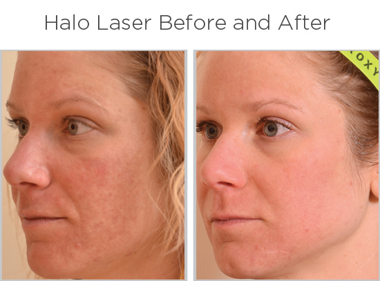 Best Procedures For 30's: Halo® By Sciton - Acqua Blu Medical Spa