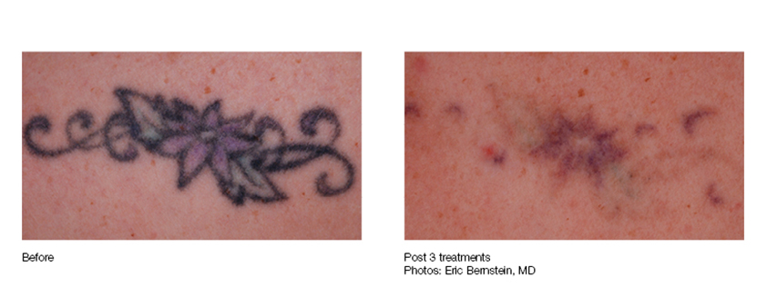 Laser Tattoo Removal  OM Laser  Wellness