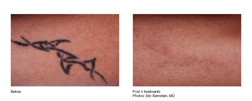 Shoulder Tattoo Removal Results | Case Study | Removery