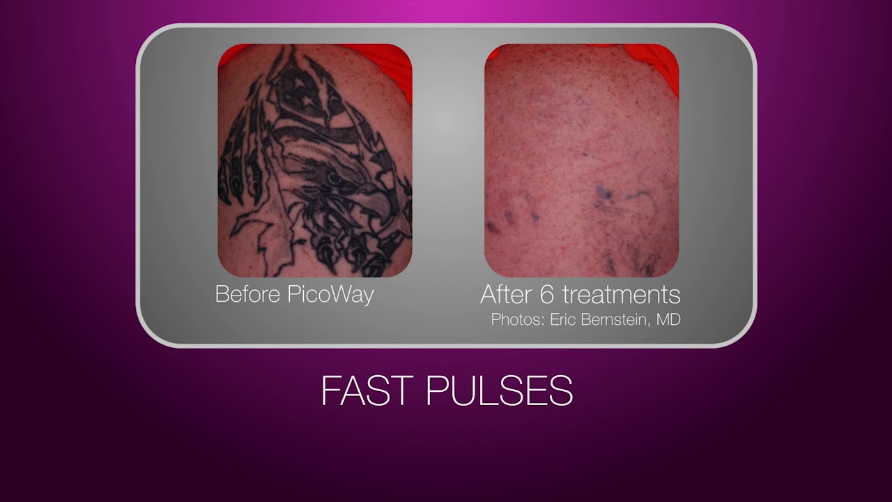 Delete Tattoo Removal  Medical Salon on Twitter Todays Before and  After PicoWay laser tattoo removal is In honor of Parents Day Our  physicians love the efficacy amp speed of our PicoWay